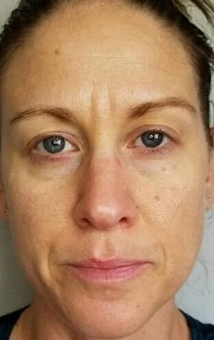 A la edad de 40 años, aparecieron arrugas profundas y puntos de edad